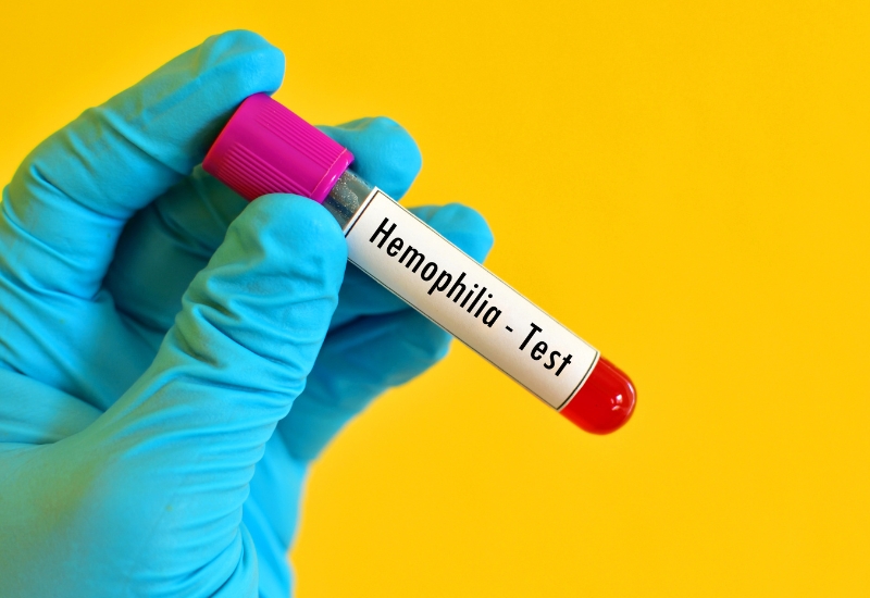xét nghiệm gen hemophilia là gì