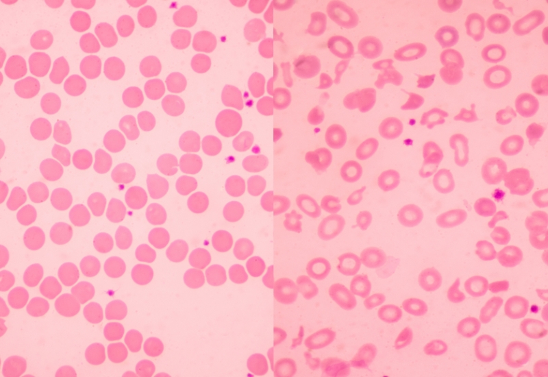 gen thalassemia có những dạng nào